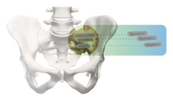 Img Ifuse Implant System